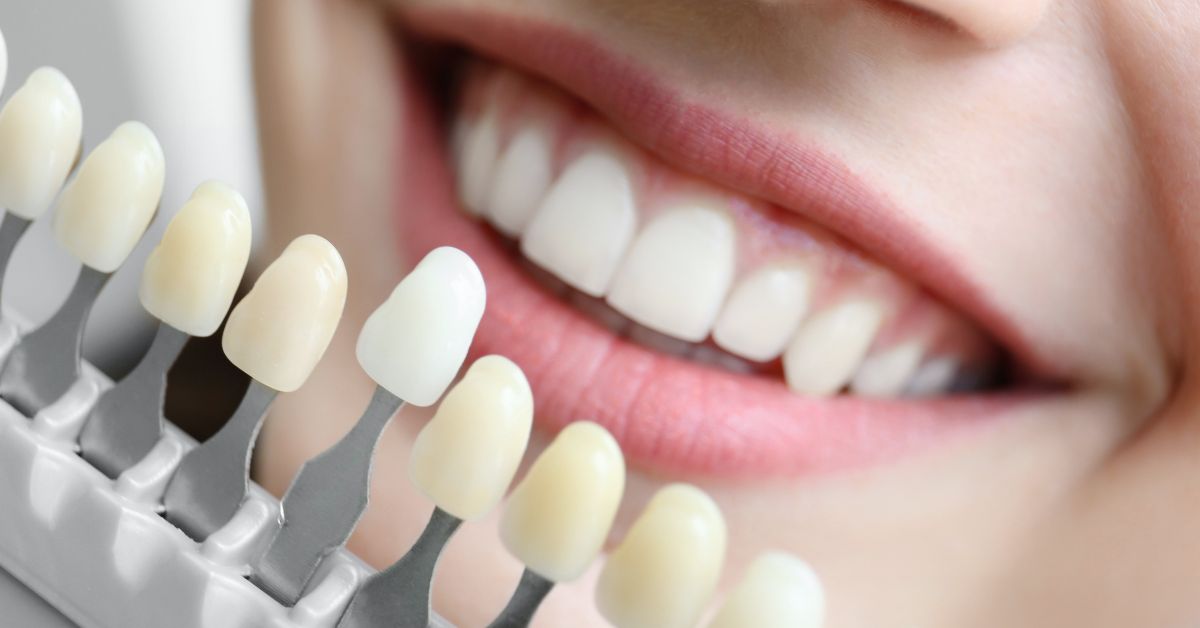 Paciente sonriendo tras blanqueamiento dental en Ceuta antes de vacaciones
